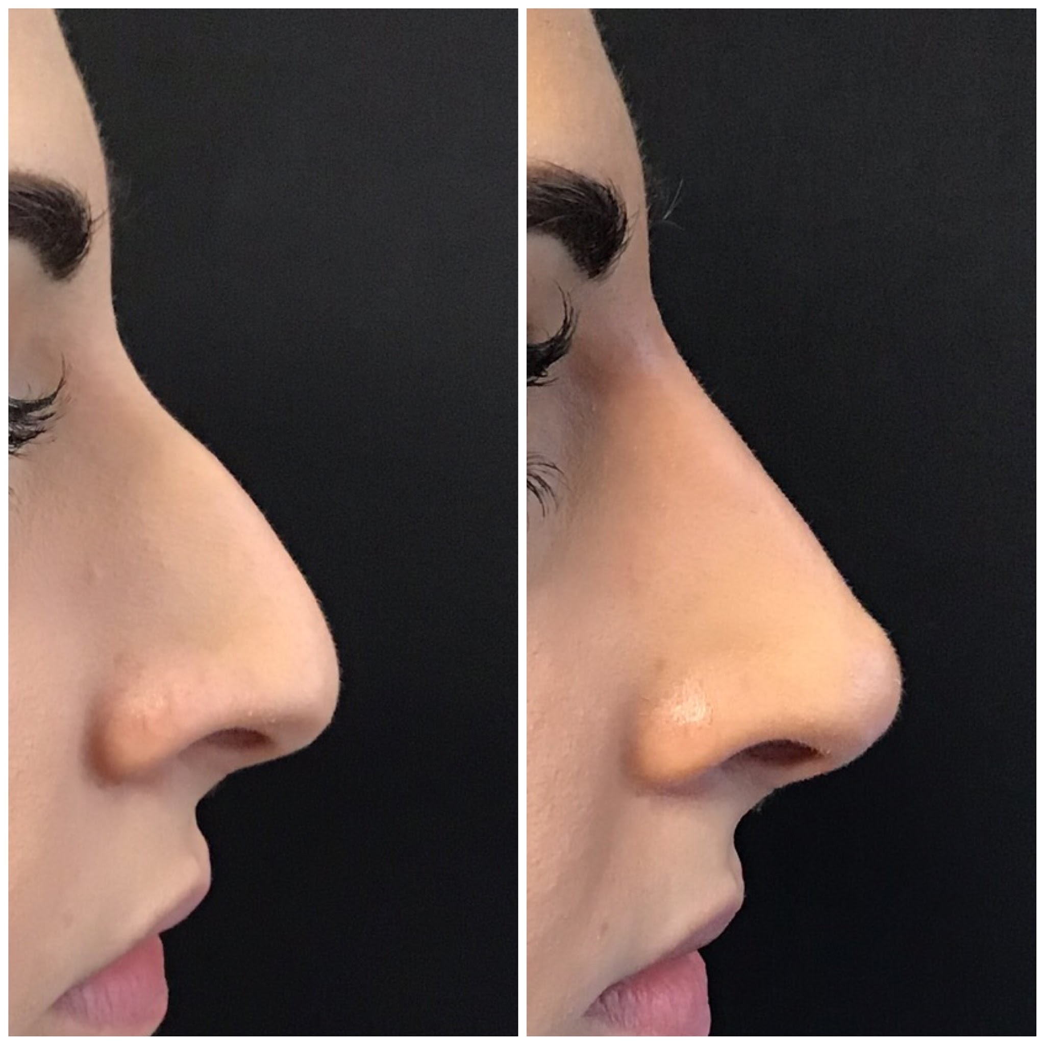 rhinoplasty experts