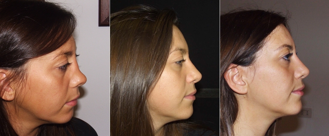 rhinoplasty experts