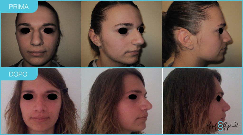 rhinoplasty experts