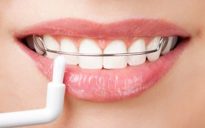 Facts of Teeth Whitening in Green Creek